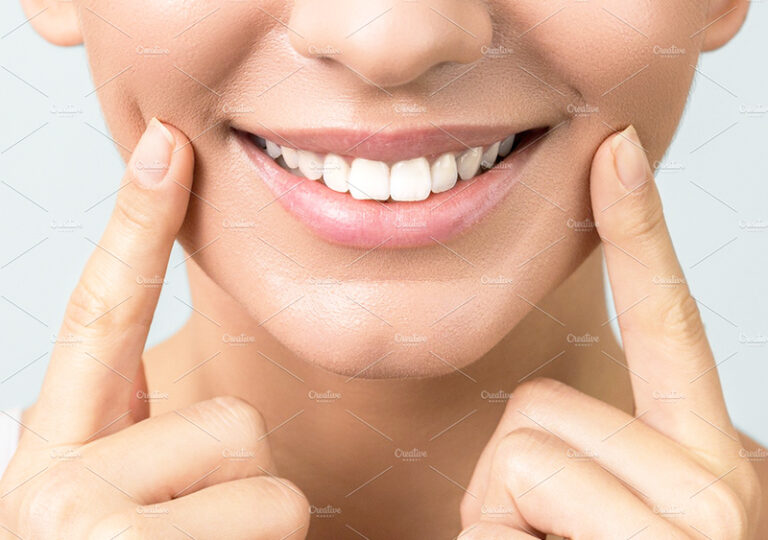 Wstawienie trzech implantów - po